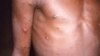 ARCHIVO - En esta imagen de 1997 proporcionada por los Centros para el Control y la Prevención de Enfermedades se muestra el brazo derecho y el torso de una persona con un caso activo de viruela símica.