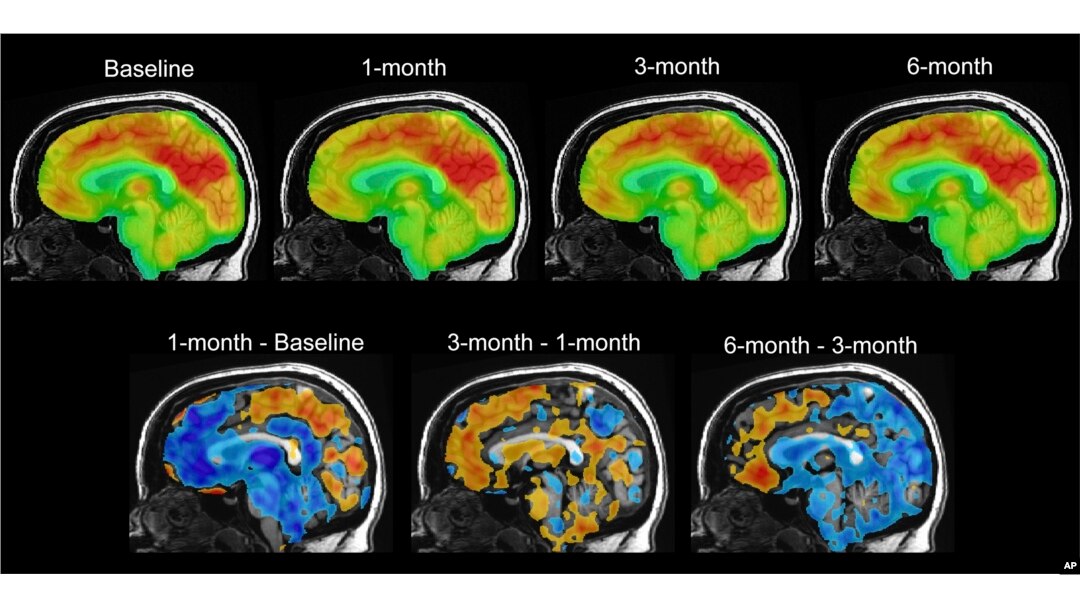 This series of PET brain scan images provided by Mount Sinai in 2024 shows changes in patient Emily Hollenbeck with deep brain stimulation therapy. (Mount Sinai via AP)